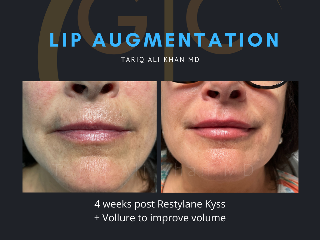 Gentle Care Laser Tustin Before and After picture - Lip Augmentation